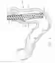 Fig. 03 - Use of biosurgical adhesive on inflatable device for gastric restriction