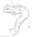 Fig. 04 - Use of biosurgical adhesive on inflatable device for gastric restriction