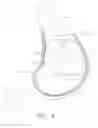 Fig. 07 - Use of biosurgical adhesive on inflatable device for gastric restriction