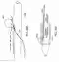 Fig. 30 - Methods of treatment using a bariatric sleeve