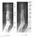 Fig. 16 - METHOD, CODE, AND SYSTEM FOR ASSAYING JOINT DEFORMITY