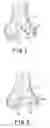 Fig. 02 - Collagen carrier of therapeutic genetic material and method