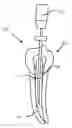 Fig. 01 - Obturation device, material and methodolgy