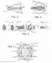 Fig. 03 - Expandable brachytherapy device with constant radiation source spacing