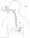 Fig. 01 - VACUUM STABILIZED OVERTUBE FOR ENDOSCOPIC SURGERY