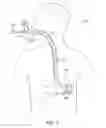 Fig. 05 - VACUUM STABILIZED OVERTUBE FOR ENDOSCOPIC SURGERY