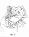 Fig. 08 - VACUUM STABILIZED OVERTUBE FOR ENDOSCOPIC SURGERY