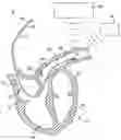 Fig. 01 - IMPLANT FOR SECURING A SENSOR IN A VESSEL