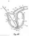 Fig. 07 - IMPLANT FOR SECURING A SENSOR IN A VESSEL