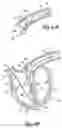 Fig. 09 - IMPLANT FOR SECURING A SENSOR IN A VESSEL