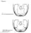 Fig. 03 - Device and method for less invasive surgical stabilization of pelvic fractures