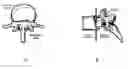 Fig. 01 - Methods of employing calcium phosphate cement compositions and osteoinductive proteins to effect vertebrae interbody fusion absent an interbody device