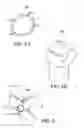 Fig. 04 - Device and method for joining vessels in anastomosis