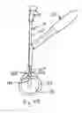 Fig. 13 - ARTERIOTOMY CLOSURE DEVICES AND TECHNIQUES