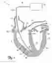 Fig. 02 - Cardiac lead with a retractable helix