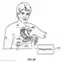 Fig. 03 - Leadless cardiac stimulation systems