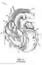 Fig. 24 - Leadless cardiac stimulation systems
