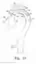 Fig. 19 - Intraoperative Anastomosis Method