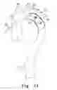 Fig. 20 - Intraoperative Anastomosis Method