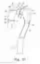 Fig. 23 - Intraoperative Anastomosis Method