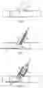 Fig. 02 - Side branch stenting system using a main vessel constraining side branch access balloon and side branching stent
