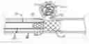 Fig. 01 - SELF-EXPANDING, PSEUDO-BRAIDED INTRAVASCULAR DEVICE