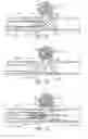 Fig. 05 - SELF-EXPANDING, PSEUDO-BRAIDED INTRAVASCULAR DEVICE