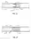 Fig. 06 - SELF-EXPANDING, PSEUDO-BRAIDED INTRAVASCULAR DEVICE