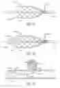Fig. 07 - SELF-EXPANDING, PSEUDO-BRAIDED INTRAVASCULAR DEVICE