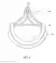 Fig. 11 - Nonstented temporary valve for cardiovascular therapy