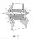 Fig. 18 - Nonstented temporary valve for cardiovascular therapy