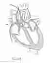 Fig. 29 - Nonstented temporary valve for cardiovascular therapy