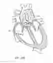 Fig. 30 - Nonstented temporary valve for cardiovascular therapy