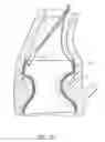 Fig. 40 - Nonstented temporary valve for cardiovascular therapy