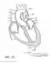 Fig. 89 - Nonstented temporary valve for cardiovascular therapy