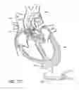 Fig. 90 - Nonstented temporary valve for cardiovascular therapy