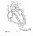 Fig. 93 - Nonstented temporary valve for cardiovascular therapy