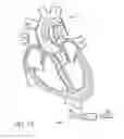 Fig. 96 - Nonstented temporary valve for cardiovascular therapy