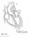 Fig. 98 - Nonstented temporary valve for cardiovascular therapy