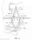 Fig. 10 - Method for Making a Bicuspid Pulmonary Heart Valve