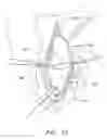 Fig. 11 - Method for Making a Bicuspid Pulmonary Heart Valve