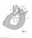 Fig. 02 - Device and method for improving the function of a heart valve