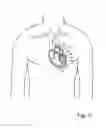 Fig. 09 - Device and method for improving the function of a heart valve