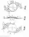 Fig. 04 - Intraocular Lens