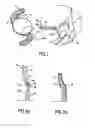 Fig. 05 - Intraocular Lens