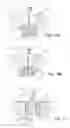 Fig. 06 - Implant, implantation device, implantation method