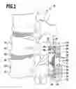 Fig. 02 - Implant for alleviating pressure on intervertebral disks and method for restoring the height of and alleviating pressure on an intervertebral space