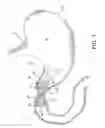 Fig. 02 - Pyloric obesity valve