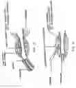 Fig. 06 - Augmentation and repair of spincter defects with cells including fibroblasts
