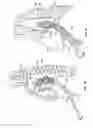 Fig. 06 - Diaphragm entry for posterior surgical access